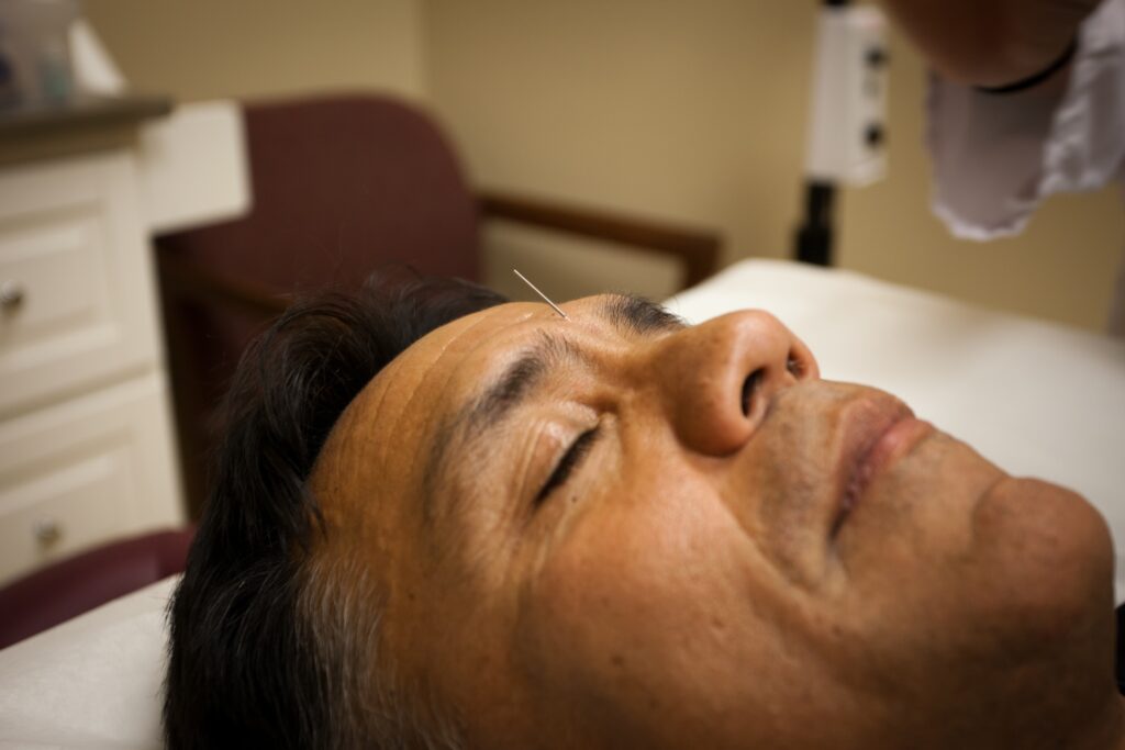 man with acupuncture needle in forehead