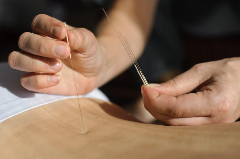 Therapist with one hand holding the needle with the other hand enters their desired point on the patient's back