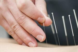 Sa'am Acupuncture - Level II